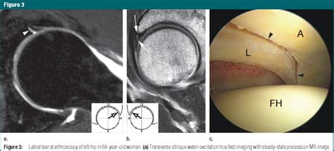 positive and negative labral tear